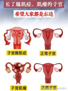 子宫腺肌症和子宫肌瘤怎么区分？-两性知识丨两性健康--你想了解的我都知道