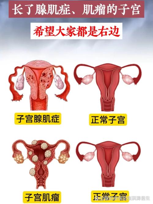 子宫腺肌症和子宫肌瘤怎么区分