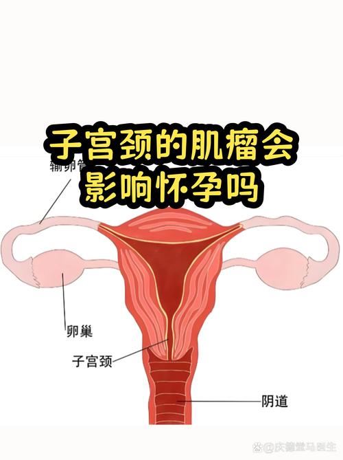 子宫肌瘤会影响怀孕吗