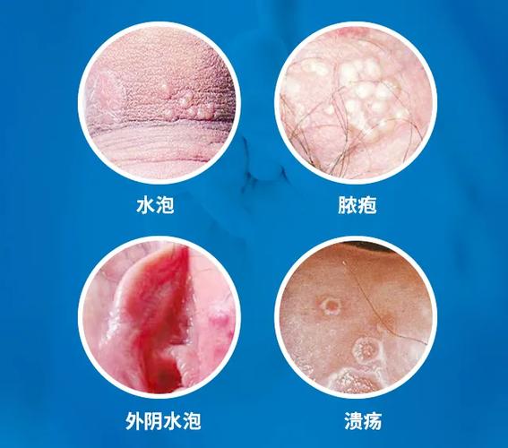 外阴长水疱要警惕什么问题