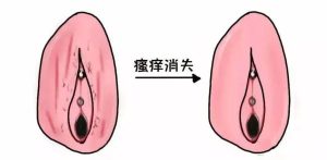 外阴夜间瘙痒要查阴虱吗？一文帮你搞清楚-两性知识丨两性健康--你想了解的我都知道