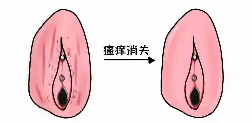 外阴夜间瘙痒要查阴虱吗