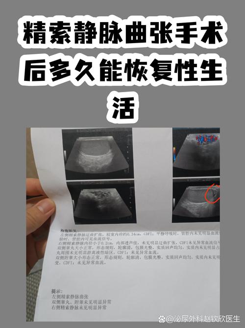 精索静脉曲张术后能恢复吗