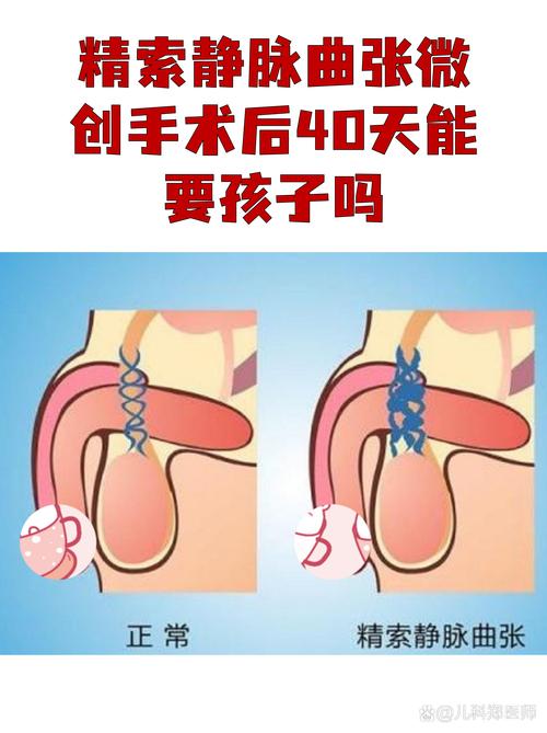 精索静脉曲张术后能恢复吗