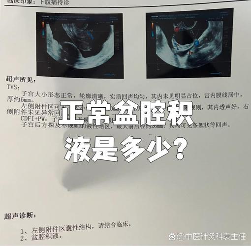 盆腔积液多少算生理性的