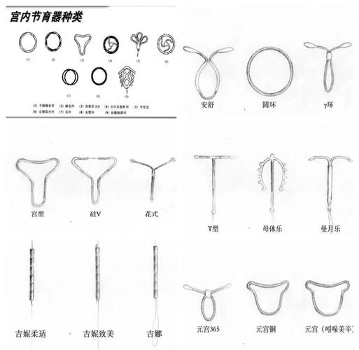 宫内节育器有哪几种类型