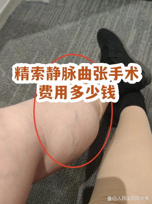 精索静脉曲张手术怎么选