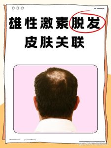 雄激素性脱发和性欲到底有没有关系?-两性知识丨两性健康--你想了解的我都知道