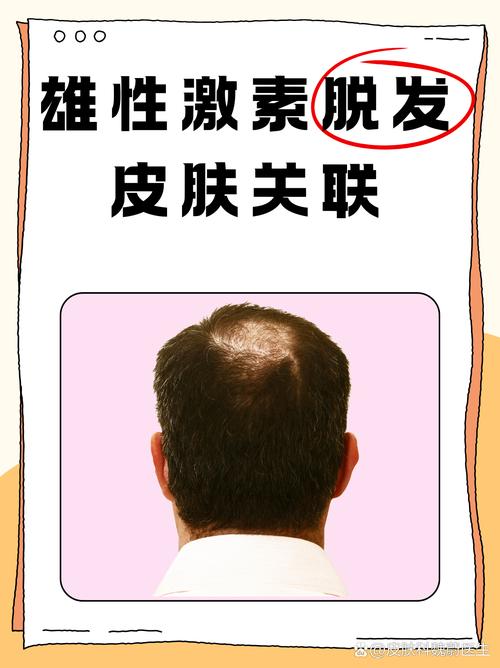 雄激素性脱发和性欲有关系吗