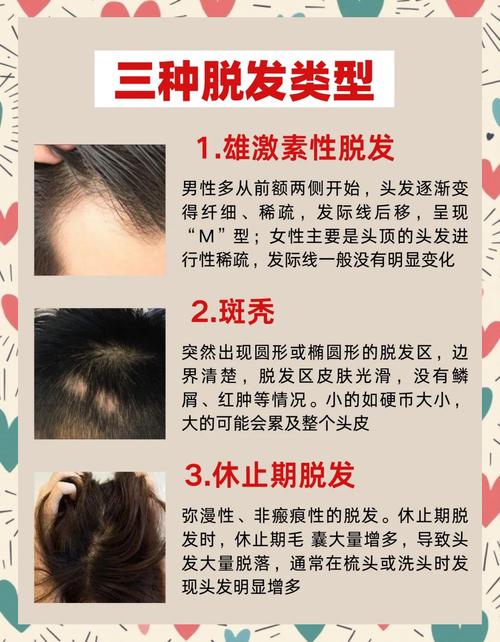 雄激素性脱发和性欲有关系吗