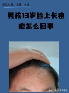 男孩长痘变多，和雄激素升高到底有没有关系？-两性知识丨两性健康--你想了解的我都知道