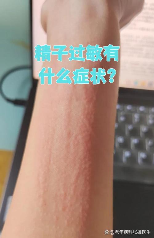 精液过敏的说法是真的吗