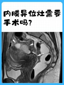 子宫内膜异位症要做核磁共振吗?一文说清什么情况才需要查-两性知识丨两性健康--你想了解的我都知道