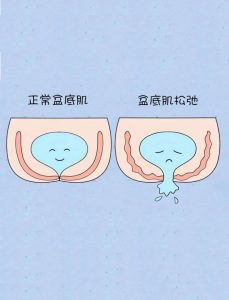 漏尿真的和盆底肌力量强弱有关吗?-两性知识丨两性健康--你想了解的我都知道
