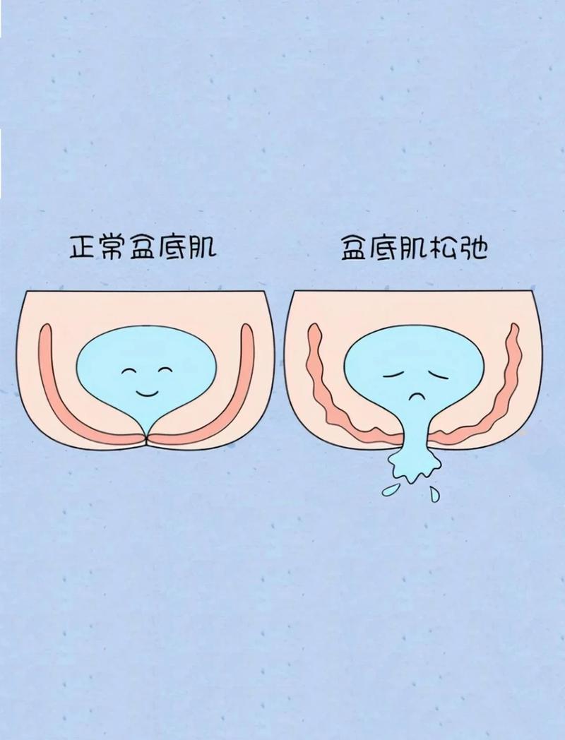 漏尿和盆底肌力量强弱有关吗