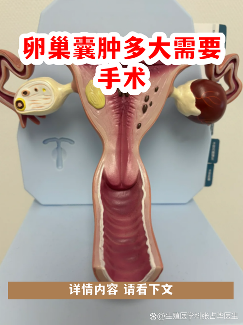 内异症囊肿多大要手术