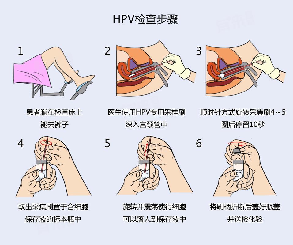 男性HPV检测怎么做,去哪查