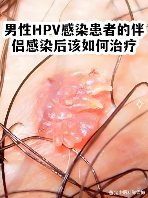 男性HPV感染需要治疗吗