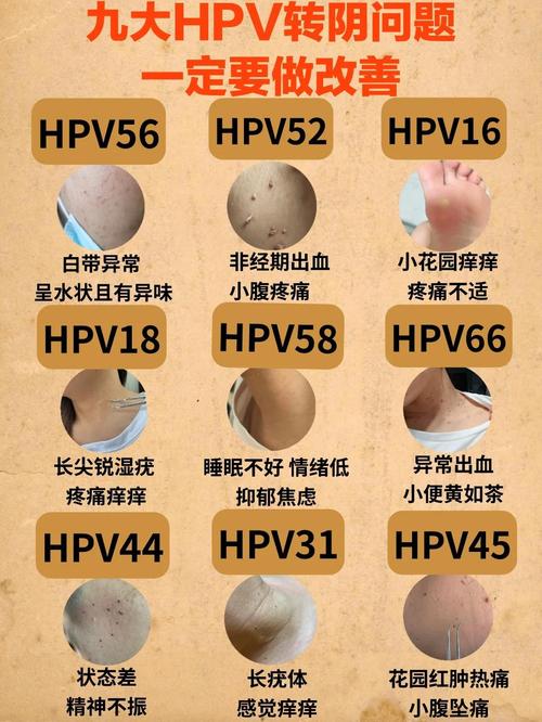 男性HPV感染需要治疗吗