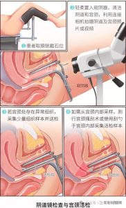 做阴道镜要提前准备什么-两性知识丨两性健康--你想了解的我都知道