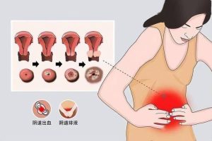 外阴癌早期会有哪些信号出现?-两性知识丨两性健康--你想了解的我都知道