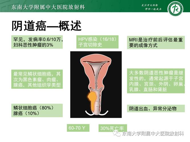 外阴癌早期表现有哪些