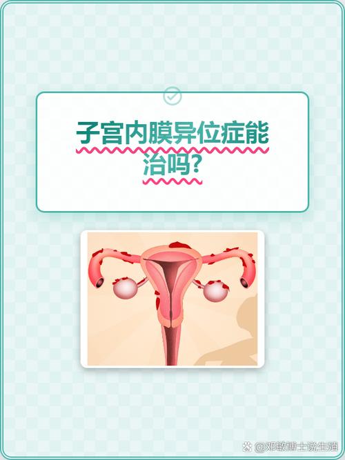 子宫内膜异位症能预防吗
