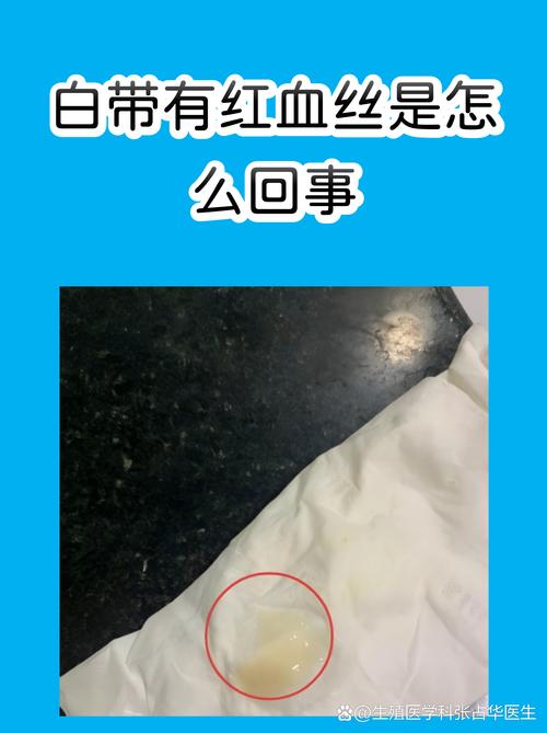 绝经后白带带血要警惕吗