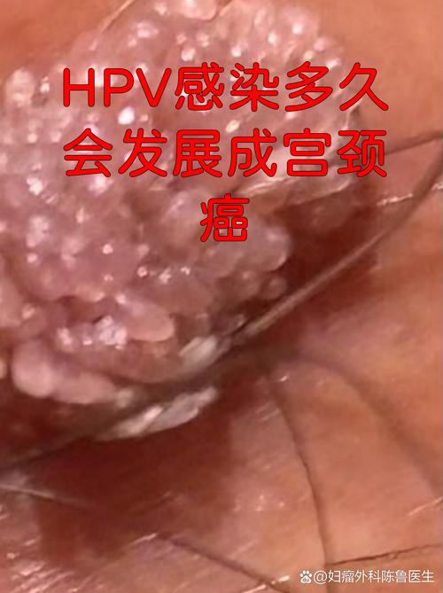 感染HPV一定会得宫颈癌吗