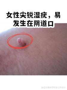 尖锐湿疣容易复发吗？复发了该怎么办？-两性知识丨两性健康--你想了解的我都知道
