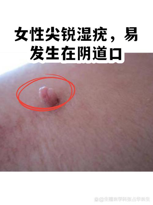 尖锐湿疣容易复发吗