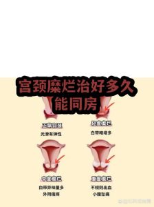 宫颈病变治疗后多久能同房?-两性知识丨两性健康--你想了解的我都知道
