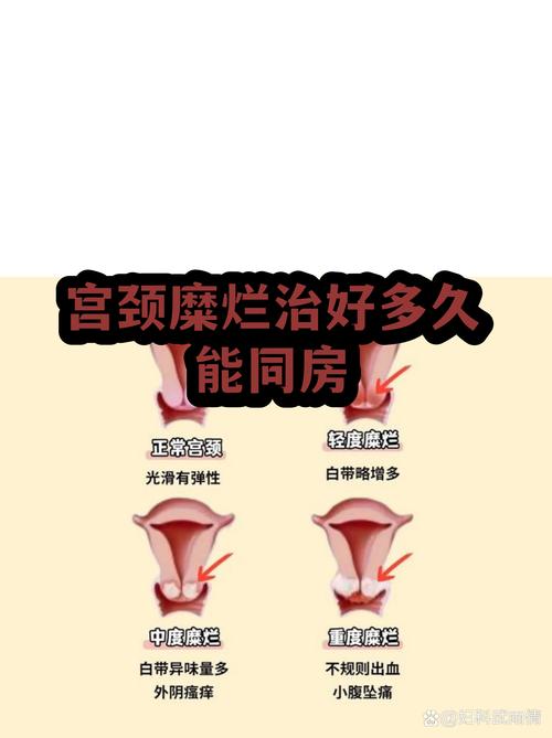 宫颈病变治疗后多久能同房