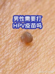 男性需要打HPV疫苗吗?这事儿真不是女生专属。-两性知识丨两性健康--你想了解的我都知道