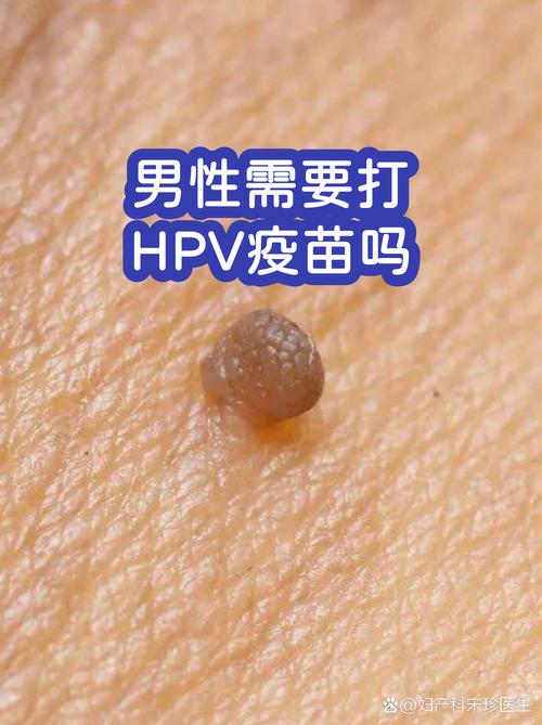 男性需要打HPV疫苗吗
