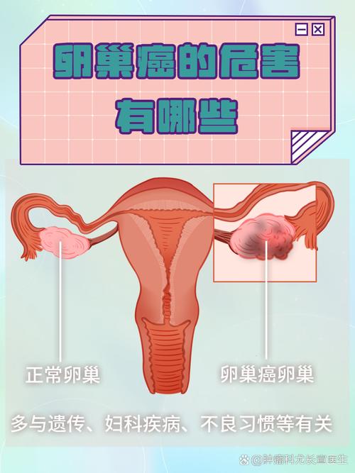 年轻女性卵巢癌能保留生育吗