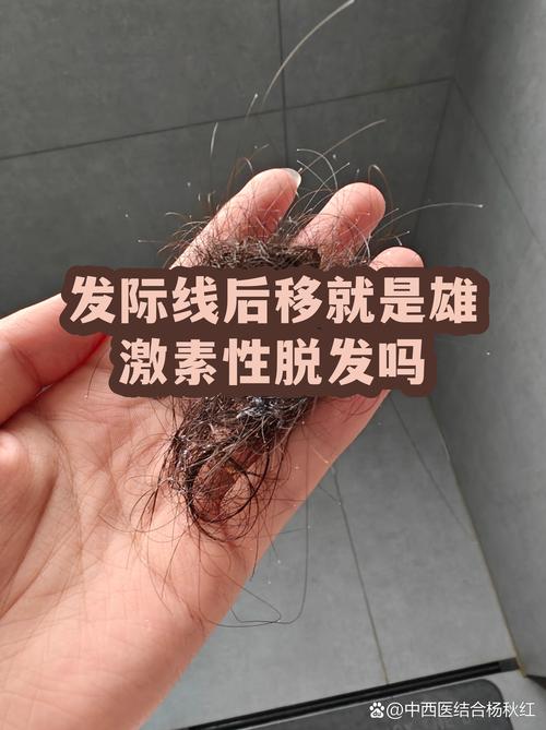 发际线后移就是脱发吗