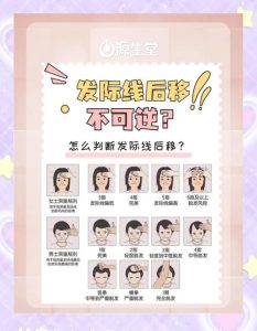 发际线后移就是脱发吗?一文帮你搞清楚!-两性知识丨两性健康--你想了解的我都知道