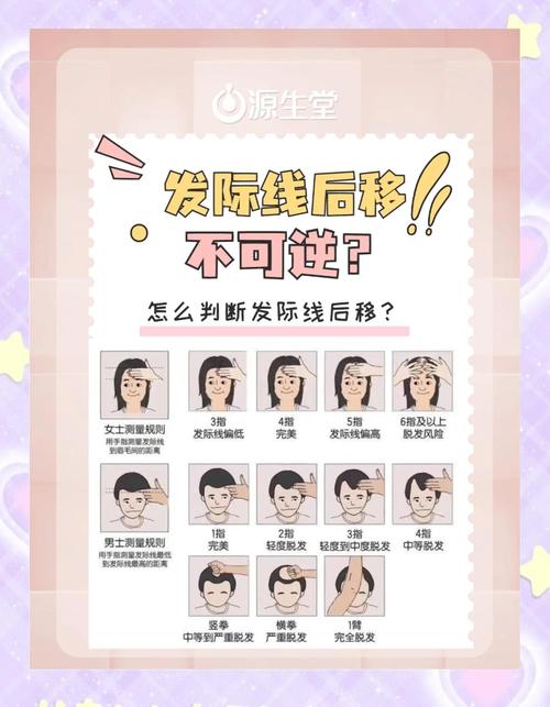 发际线后移就是脱发吗