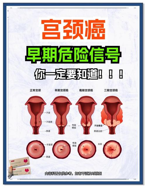宫颈病变能保守观察吗