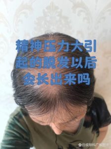 压力大会引起脱发吗-两性知识丨两性健康--你想了解的我都知道