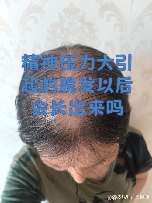 压力大会引起脱发吗