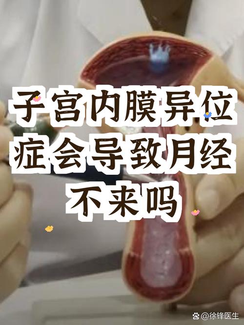子宫内膜异位症会影响月经吗