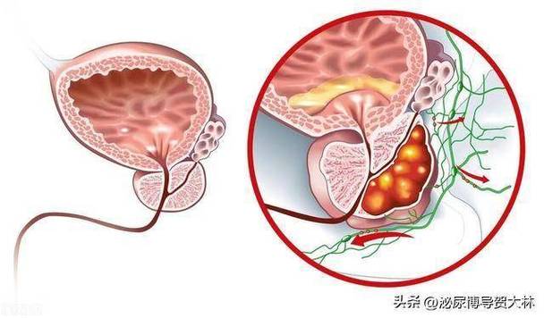 前列腺癌内分泌治疗有什么影响