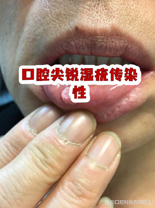 口腔接触会传染性病吗