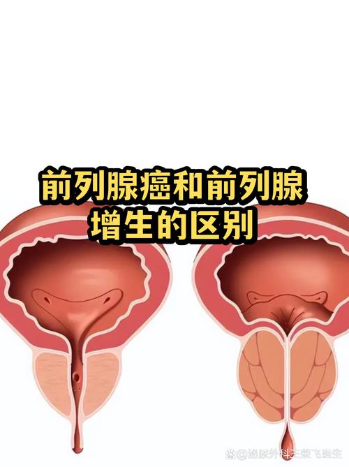 前列腺增生不治,会变癌吗
