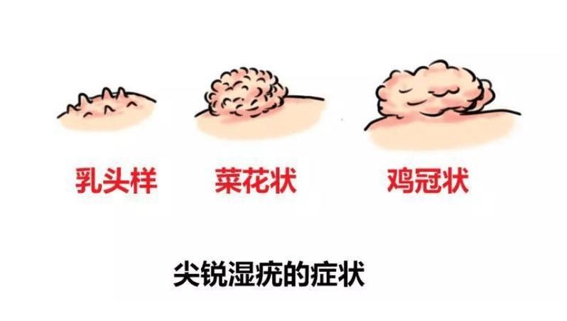 生殖器出现溃疡,要警惕什么