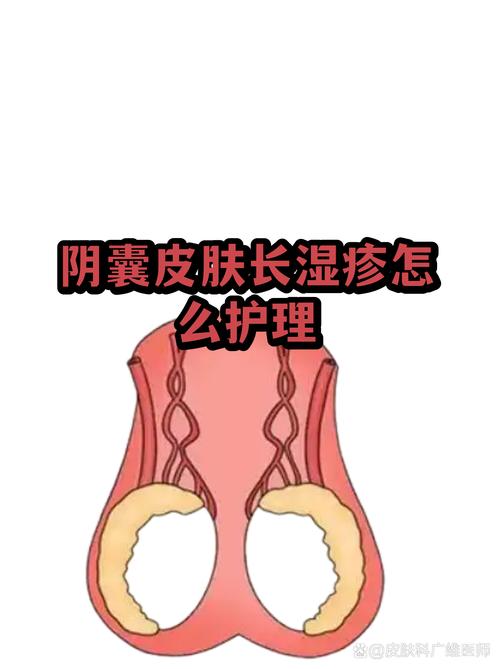 阴囊湿疹怎么治，怎么防复发