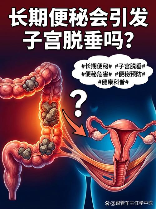 长期便秘会加重子宫脱垂吗