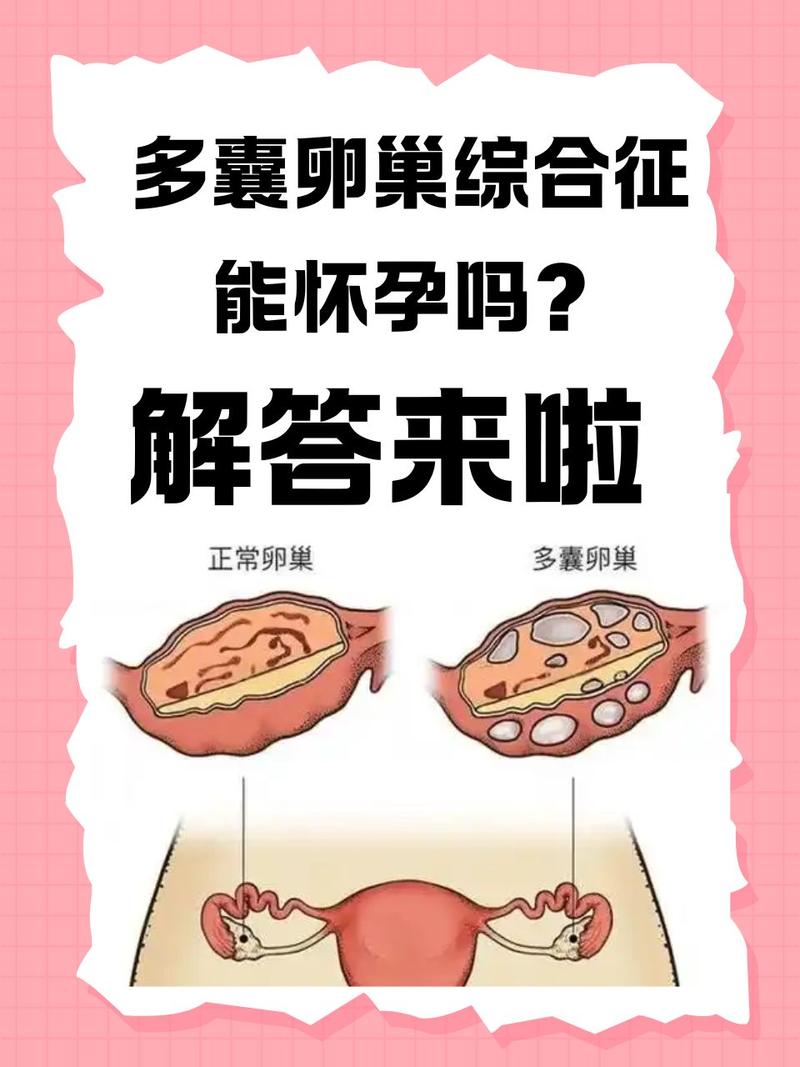 多囊卵巢综合征能预防吗